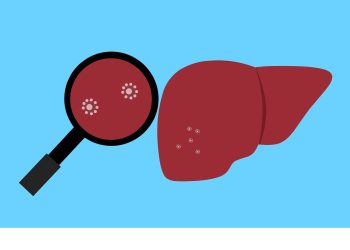 ACSS2, nuovo bersaglio per le metastasi epatiche