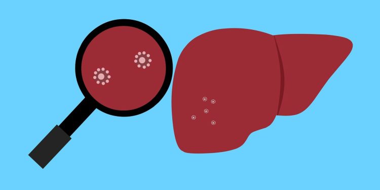 ACSS2, nuovo bersaglio per le metastasi epatiche