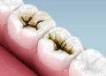 Carie infantili, il liquido che può fermarle senza trapano