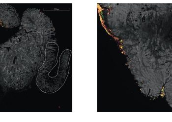 Tumore colorettale, Fusobacterium associato alle recidive