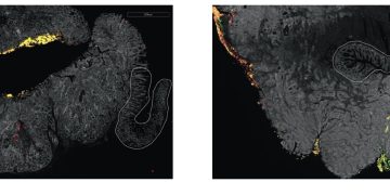 Tumore colorettale, Fusobacterium associato alle recidive