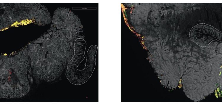 Tumore colorettale, Fusobacterium associato alle recidive